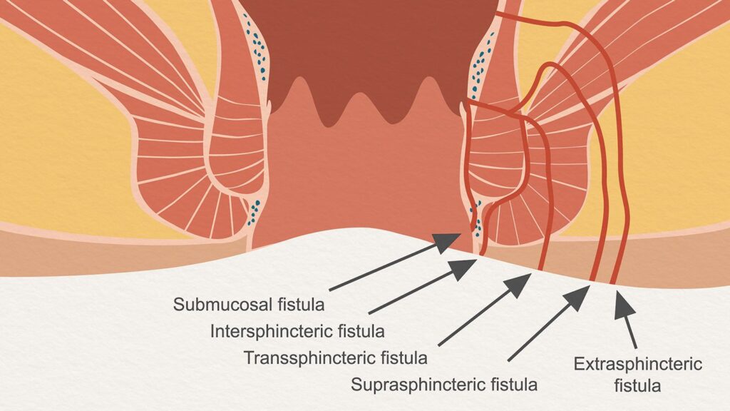 How to cure fistula permanently?